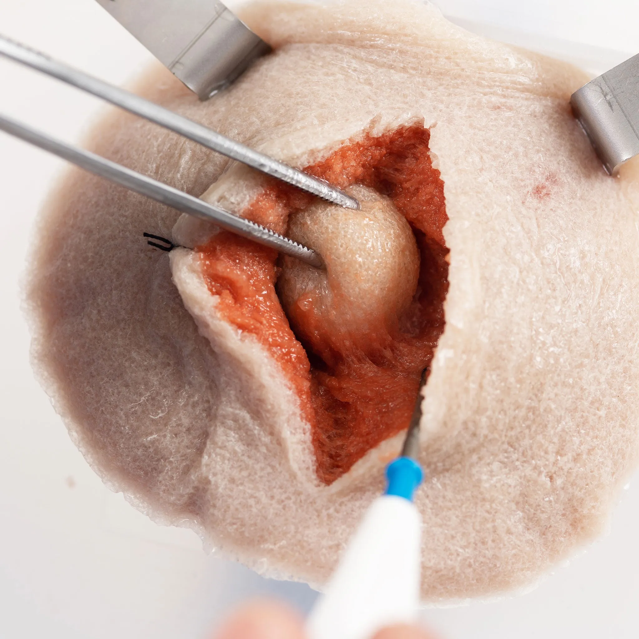 Composite Tumor Model